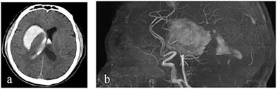 Intracerebral hemorrhage associated with brucellosis: A case report